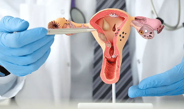 gejala pcos