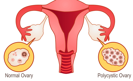 penyebab pcos pada wanita